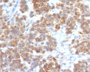 Immunohistochemistry of VEGI antibody in human parathyroid mass tissue. FFPE human parathyroid lesion demonstrates diffuse cytoplasmic and membranous HRP-DAB brown staining within tumor cells, consistent with Vascular endothelial growth inhibitor / TNFSF15 expression in endocrine-associated tissue. Clone TLRM1-2R was used as a recombinant rabbit monoclonal antibody for detection. Heat-induced epitope retrieval was performed by boiling sections in 10 mM Tris with 1 mM EDTA, pH 9, for 10-20 minutes followed by cooling at room temperature for 20 minutes prior to staining.
