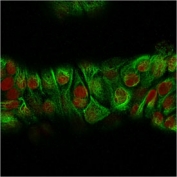 IHC testing of FFPE human prostate cancer with recombinant Basic Cytokeratin antibody (clone KRTH/2147R). Required HIER: boil tissue sections in 10mM citrate buffer, pH 6, for 10-20 min followed by cooling at RT for 20 min.