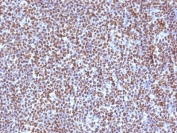 ALK Antibody ALCL IHC. Immunohistochemistry staining of FFPE human anaplastic large-cell lymphoma tissue using monoclonal clone ALK/1504 demonstrates strong diffuse nuclear and cytoplasmic HRP-DAB brown staining throughout neoplastic lymphoid cells, consistent with ALK fusion-associated protein expression in ALK-positive lymphoma. The widespread staining pattern supports activation of oncogenic ALK signaling pathways characteristic of anaplastic large-cell lymphoma biology. HIER: boil tissue sections in pH6, 10mM citrate buffer, for 10-20 min followed by cooling at room temperature for 20 min.