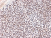 ALK Antibody Ewing Sarcoma IHC. Immunohistochemistry staining of FFPE human Ewing's sarcoma tissue using monoclonal clone ALK/1504 reveals widespread nuclear and cytoplasmic HRP-DAB brown staining in malignant small round tumor cells. The observed staining distribution supports detection of ALK-associated signaling protein expression within sarcoma-derived neoplastic tissue compartments. HIER: boil tissue sections in pH6, 10mM citrate buffer, for 10-20 min followed by cooling at room temperature for 20 min.