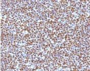 ALK Antibody Lymphoma Cell Marker IHC. Immunohistochemistry staining of FFPE human anaplastic large-cell lymphoma tissue using monoclonal clone ATKR-1 demonstrates extensive nuclear and cytoplasmic HRP-DAB brown staining in neoplastic lymphoid cells, highlighting the characteristic ALK-associated staining profile observed in ALK-positive lymphoma. The intense tumor cell labeling supports detection of oncogenic ALK fusion protein expression within lymphoma-associated cellular populations. HIER: boil tissue sections in pH6, 10mM citrate buffer, for 10-20 min followed by cooling at room temperature for 20 min.