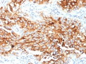Mesothelin Antibody Lung Mesothelioma IHC. Immunohistochemistry analysis of mesothelin expression in FFPE human lung mesothelioma using clone MSLN/2131. Strong membranous HRP-DAB brown staining is observed across tumor cells with accompanying cytoplasmic signal, consistent with mesothelin cell surface localization and processing. The staining pattern highlights cohesive tumor cell architecture and clearly distinguishes mesothelioma cells from surrounding stromal components, supporting its use as a tumor marker in tissue sections. Heat-induced epitope retrieval was performed using pH 9 Tris-EDTA buffer.