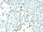 Biotinylated Mesothelin Antibody Human Lung IHC. Immunohistochemistry analysis of mesothelin expression in FFPE human lung using biotinylated clone MSLN/2131. Focal membranous HRP-DAB brown staining is observed in epithelial structures with low background in surrounding tissue, consistent with limited physiologic mesothelin expression. The biotinylated detection format enhances signal visibility and improves contrast, supporting detection of low-level expression in normal tissue compartments. Heat-induced epitope retrieval was performed using pH 9 Tris-EDTA buffer.