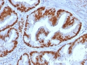 Immunohistochemistry of ER alpha Antibody HuProt Array Validated in human endometrial carcinoma. Formalin-fixed, paraffin-embedded human endometrial carcinoma tissue shows strong nuclear HRP-DAB brown staining in malignant glandular epithelial cells, while surrounding stromal elements demonstrate reduced staining intensity. Staining was performed using clone ESR1/1935 following heat-induced epitope retrieval by boiling tissue sections in pH 9 10 mM Tris buffer with 1 mM EDTA for 10-20 min and cooling at room temperature for 20 min. The nuclear staining pattern is consistent with expected Estrogen Receptor alpha / ESR1 expression in hormone-responsive endometrial carcinoma cells.