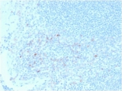 CD25 Antibody Tonsil Immunohistochemistry. IHC testing of FFPE human tonsil tissue with CD25 antibody (clone IL2RA/2395). HIER: boil tissue sections in pH6, 10mM citrate buffer, for 10-20 min followed by cooling at RT for 20 min.