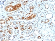 Mammaglobin Antibody - Protein Microarray Validated - immunohistochemistry of human breast carcinoma. FFPE human breast carcinoma tissue was stained with Mammaglobin Antibody - Protein Microarray Validated (clone MGB/2000) to detect Mammaglobin A / SCGB2A2. HRP-DAB brown chromogenic signal highlights cytoplasmic staining in carcinoma epithelial cells within glandular tumor structures, consistent with the secretory localization of this breast-associated protein. Surrounding stromal cells show minimal staining. Heat-induced epitope retrieval was performed by boiling tissue sections in 10mM citrate buffer (pH6) for 10-20 minutes followed by cooling at room temperature for 20 minutes prior to staining.
