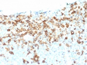 IHC testing of FFPE human melanoma tissue with NGF Receptor antibody (clone NGFR/1964). HIER: boil tissue sections in pH6, 10mM citrate buffer, for 10-20 min followed by cooling at RT for 20 min.