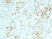 Immunohistochemistry analysis of STAT3 antibody in human renal cell carcinoma tissue (clone STAT6/2410). FFPE human renal cell carcinoma sections demonstrate HRP-DAB brown cytoplasmic and nuclear staining in tumor cells forming glandular and tubular structures. The staining pattern highlights both cytoplasmic localization and nuclear accumulation consistent with activated Signal transducer and activator of transcription 3 in neoplastic epithelial cells. Surrounding stromal components show minimal background staining. Heat induced epitope retrieval was performed in pH 6, 10 mM citrate buffer by boiling tissue sections for 10-20 minutes followed by cooling at room temperature for 20 minutes prior to antibody incubation.