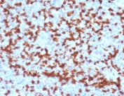 ZAP70 Antibody / T-cell Activation Threshold Antibody. Immunohistochemistry analysis of formalin-fixed, paraffin-embedded human tonsil tissue using ZAP70 Antibody / T-cell Activation Threshold Antibody (clone ZPT70-2). Antigen retrieval was performed by boiling sections in pH 9 Tris-EDTA buffer for 10-20 minutes followed by cooling at room temperature. Cytoplasmic HRP-DAB brown staining is observed in dense lymphoid cell populations within tonsillar follicles and interfollicular regions, with variable staining intensity across adjacent cells. This heterogeneous pattern is consistent with Zeta-chain-associated protein kinase 70 (ZAP70) expression reflecting differences in signaling sensitivity and activation thresholds among lymphocytes. The staining highlights subsets of cells with varying activation potential, supporting the role of ZAP70 in regulating signal strength discrimination within lymphoid tissue architecture.