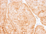 GLUT1 Antibody Protein Microarray Validated clone GLUT1/2475 immunohistochemistry analysis in human bladder carcinoma tissue. FFPE human bladder carcinoma section shows strong HRP-DAB brown membranous and cytoplasmic staining in tumor epithelial cells, consistent with GLUT1 (SLC2A1) localization in metabolically active cancer cell populations with elevated glucose uptake. Tumor cell nests display prominent membrane-associated staining while surrounding stromal regions show minimal background signal. Heat-induced epitope retrieval was performed by boiling tissue sections in pH 9, 10 mM Tris with 1 mM EDTA for 10-20 minutes followed by cooling at room temperature prior to antibody staining.