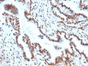 TLE1 Antibody / Transcriptional Corepressor immunohistochemistry analysis of human endometrial carcinoma. Formalin-fixed paraffin-embedded human endometrial carcinoma tissue stained with TLE1 Antibody / Transcriptional Corepressor (clone TLE1/2051) shows strong nuclear HRP-DAB brown staining in tumor epithelial cells, consistent with the nuclear localization of the TLE1 transcriptional corepressor. Transducin-Like Enhancer Protein 1 functions as a Groucho family transcriptional corepressor that regulates gene repression through interactions with transcription factors and chromatin-associated regulatory complexes. Heat-induced epitope retrieval was performed by boiling tissue sections in pH 9 Tris-EDTA buffer for 10-20 minutes followed by cooling at room temperature prior to immunohistochemical staining.