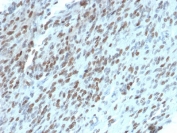 TLE1 Antibody Protein Microarray Validated Clone TLE1/2062 immunohistochemistry analysis of human gastrointestinal stromal tumor (GIST). Formalin-fixed paraffin-embedded human GIST tissue shows nuclear staining in tumor cells consistent with expression of Transducin-Like Enhancer Protein 1, a nuclear transcriptional corepressor belonging to the Groucho/TLE family of transcriptional regulators. Clone TLE1/2062 is a protein microarray validated antibody, indicating specificity assessment using large-scale protein microarray screening to evaluate antibody binding across extensive protein panels. Nuclear staining highlights tumor cells within the gastrointestinal stromal tumor while surrounding stromal elements show weaker or absent signal. Heat-induced epitope retrieval was performed by boiling tissue sections in pH 9 Tris-EDTA buffer for 10-20 minutes followed by cooling at room temperature prior to antibody staining.