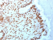 TLE1 Antibody Protein Microarray Validated Clone TLE1/2062 immunohistochemistry analysis of human endometrial carcinoma. Formalin-fixed paraffin-embedded human endometrial carcinoma tissue shows strong nuclear staining in tumor cells consistent with expression of Transducin-Like Enhancer Protein 1, a nuclear transcriptional corepressor belonging to the Groucho/TLE family of transcriptional regulators. Clone TLE1/2062 is a Protein Microarray Validated antibody, indicating antibody specificity was evaluated using large-scale protein microarray screening across extensive protein panels. Nuclear staining highlights malignant epithelial cells while surrounding stromal components show weaker or minimal signal. Heat-induced epitope retrieval was performed by boiling tissue sections in pH 9 Tris-EDTA buffer for 10-20 minutes followed by cooling at room temperature prior to antibody staining.