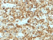 PMEL17 Antibody Glycosylated Protein. Immunohistochemistry analysis of human melanoma tissue stained with PMEL17 Antibody Glycosylated Protein clone PMEL/2037. Tumor cells display strong cytoplasmic HRP-DAB brown chromogenic staining consistent with expression of Premelanosome protein PMEL, also known as gp100, a melanosome-associated glycoprotein characteristic of melanocytic lineage. Positive staining highlights melanoma tumor cells distributed throughout the tissue section, while surrounding stromal elements show minimal background staining. Heat-induced epitope retrieval was performed by boiling sections in 10mM citrate buffer pH 6 for 10-20 minutes followed by cooling at room temperature prior to staining.