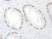 p63 Antibody Prostate Cancer Marker IHC. Immunohistochemistry analysis of Tumor protein 63 (TP63) in FFPE human prostate carcinoma tissue using a p63 antibody as a prostate cancer marker (clone TP63/2427) demonstrates distinct HRP-DAB brown nuclear staining in residual basal cells outlining benign glands, while malignant glandular epithelial cells remain negative. The continuous basal cell layer is clearly visible in non-neoplastic glands, forming a ring-like nuclear staining pattern, whereas carcinoma glands lack this basal cell staining, reflecting loss of basal epithelial architecture. This contrast provides a clear visual distinction between benign and malignant structures within the same tissue section. The nuclear-restricted signal with low background supports accurate interpretation of TP63 expression and reinforces its role as a marker of basal cell integrity in prostate tissue. Heat-induced epitope retrieval was performed by boiling tissue sections in pH 9 10mM Tris with 1mM EDTA for 10-20 minutes followed by cooling at room temperature for 20 minutes prior to antibody incubation.