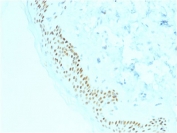 p63 Antibody Basal Cell Carcinoma IHC. Immunohistochemistry analysis of Tumor protein 63 (TP63) in FFPE human basal cell carcinoma tissue using a p63 antibody as a basal cell marker (clone TP63/2428) demonstrates strong HRP-DAB brown nuclear staining in tumor cells with basal-like morphology. The staining is diffuse and nuclear, highlighting the expansion of TP63-positive basal cell populations within the tumor and supporting its identity as a basal cell-derived carcinoma. Surrounding stromal components remain negative, providing clear contrast and reinforcing the lineage-specific expression pattern. The crisp nuclear localization and widespread tumor cell positivity are consistent with the role of TP63 in basal cell maintenance and epithelial proliferation. Heat-induced epitope retrieval was performed by boiling tissue sections in pH 9 10mM Tris with 1mM EDTA for 10-20 minutes followed by cooling at room temperature for 20 minutes prior to antibody incubation.