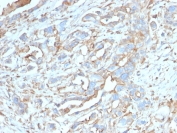 PD-L1 Antibody Breast Carcinoma IHC. Immunohistochemistry analysis of PD-L1 (CD274) expression in FFPE human breast carcinoma using clone PDL1/2746. The antibody demonstrates membranous HRP-DAB brown staining in tumor epithelial cells with additional signal in tumor-associated immune cells, highlighting immune checkpoint activity within the tumor microenvironment. The staining pattern shows heterogeneous expression across tumor regions, supporting evaluation of tumor-immune interactions and PD-L1-associated signaling. Heat-induced epitope retrieval was performed using pH 9 Tris-EDTA buffer.