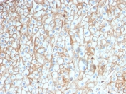 PD-L1 Antibody Lung Squamous Cell Carcinoma IHC. Immunohistochemistry analysis of PD-L1 (CD274) expression in FFPE human lung squamous cell carcinoma using clone PDL1/2746. The antibody demonstrates strong membranous HRP-DAB brown staining in tumor epithelial cells, with additional signal in tumor-associated immune cells, reflecting active immune checkpoint signaling within the tumor microenvironment. The staining pattern shows regionally heterogeneous expression across tumor nests, supporting evaluation of PD-L1 distribution and tumor-immune interactions. Heat-induced epitope retrieval was performed using pH 9 Tris-EDTA buffer.