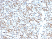 PD-L1 Biotinylated Antibody Lung Carcinoma IHC. Immunohistochemistry analysis of PD-L1 (CD274) expression in FFPE human lung carcinoma using biotin-conjugated clone PDL1/2746. The antibody demonstrates membranous HRP-DAB brown staining in tumor epithelial cells with additional signal in tumor-associated immune cells, consistent with immune checkpoint activity within the tumor microenvironment. Biotin-streptavidin amplification enhances detection of both strong and lower-level PD-L1 expression, supporting improved visualization of heterogeneous staining across tumor regions. Heat-induced epitope retrieval was performed using pH 9 Tris-EDTA buffer.