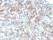 PD-L1 Biotinylated Antibody Lung Carcinoma Tissue IHC. Immunohistochemistry analysis of PD-L1 (CD274) expression in FFPE human lung carcinoma using biotin-conjugated clone PDL1/2746. The antibody demonstrates strong membranous HRP-DAB brown staining in tumor cells with additional labeling of tumor-associated immune cells, consistent with checkpoint-related expression in the tumor microenvironment. Biotin-based detection supports enhanced signal intensity and improved sensitivity, enabling clear visualization of both high and moderate PD-L1 expression across tumor regions. Heat-induced epitope retrieval was performed using pH 9 Tris-EDTA buffer.