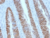 Recombinant CDX2 Antibody Human Colon Carcinoma Tissue IHC. Immunohistochemistry testing of FFPE human colon carcinoma with recombinant CDX2 antibody (clone CDX2/2951R). HIER: boil tissue sections in 10mM Tris with 1mM EDTA, pH 9, for 10-20 min followed by cooling prior to testing.