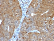 AKR1B1 Antibody Prostate Cancer IHC. Immunohistochemistry testing of FFPE human prostate cancer with AKR1B1 antibody (clone ADRD1-1). Required HIER: boil tissue sections in 10mM citrate buffer, pH6, for 10-20 min followed by cooling at RT for 20 min.