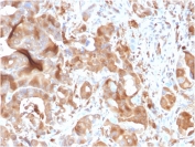 v testing of FFPE human hepatic carcinoma with FABP5 antibody. HIER: boiling tissue sections in pH 9 10mM Tris with 1mM EDTA for 10-20 min and allow to cool prior to staining.