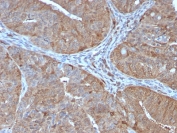 AKR1B1 Antibody Prostate IHC. Immunohistochemistry analysis of FFPE human prostate tissue stained with AKR1B1 Antibody clone CPTC-AKR1B1-2. Strong cytoplasmic HRP-DAB brown staining is observed throughout glandular epithelial cells, consistent with the expected intracellular localization of Aldose reductase / AKR1B1, an oxidative stress-associated metabolic enzyme involved in reactive aldehyde detoxification, glucose-responsive signaling, and cellular redox regulatory pathways. Tissue sections underwent HIER using 10mM citrate buffer, pH 6, prior to immunostaining.