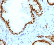 IHC staining of FFPE human prostate carcinoma with recombinant ATRX antibody (clone ATMRX-1R). HIER: boil tissue sections in 10mM Tris with 1mM EDTA buffer, pH 9, for 10-20 min followed by cooling at RT for 20 min.