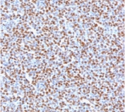 ALK Antibody Neoplastic Lymphoid Cell IHC. Immunohistochemistry staining of FFPE human anaplastic large-cell lymphoma tissue using recombinant monoclonal clone ATKR-2R demonstrates strong nuclear and cytoplasmic HRP-DAB brown staining in malignant lymphoid cells, supporting detection of ALK fusion-associated oncogenic kinase expression within lymphoma-derived tumor tissue. The staining pattern is characteristic of ALK-positive anaplastic large-cell lymphoma and associated receptor tyrosine kinase pathway activation. HIER: boil tissue sections in 10mM Tris buffer with 1mM EDTA, pH 9, for 10-20 min followed by cooling at room temperature for 20 min.