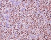 IHC staining of FFPE human seminoma tissue with OCT4 antibody (clone OCT4/6847R) at 2ug/ml. HIER: boil tissue sections in pH 9 10mM Tris with 1mM EDTA for 20 min and allow to cool before testing.