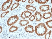 SATB2 Antibody Human Colon Tissue Immunohistochemistry. IHC staining of FFPE human colon tissue with SATB2 antibody (clone SATB2/7111). HIER: boil tissue sections in pH 9 10mM Tris with 1mM EDTA for 20 min and allow to cool before testing.