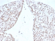 Recombinant Steroidogenic Factor 1 Antibody Renal Oncocytoma IHC. Immunohistochemistry staining of FFPE human renal oncocytoma with Recombinant Steroidogenic Factor 1 antibody (clone rNR5A1/4369). HIER: boil tissue sections in pH 9 10mM Tris with 1mM EDTA for 20 min and allow to cool before testing.
