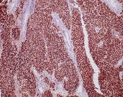 Recombinant GATA Binding Protein 3 Antibody Urothelial Carcinoma IHC. Immunohistochemistry analysis of FFPE human urothelial carcinoma tissue stained with recombinant GATA Binding Protein 3 antibody clone rGATA3/3870 demonstrates strong diffuse nuclear HRP-DAB brown staining throughout malignant urothelial cell populations, consistent with the established role of GATA binding protein 3 / GATA3 in urothelial differentiation and epithelial lineage-associated transcriptional regulation. The extensive nuclear staining pattern supports the utility of GATA3 as a marker of urothelial epithelial identity in bladder carcinoma-associated tissue studies. HIER: boil tissue sections in pH 9 10mM Tris with 1mM EDTA for 20 min and allow to cool before testing.