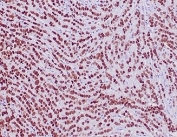 Recombinant GATA Binding Protein 3 Antibody Lobular Breast Carcinoma IHC. Immunohistochemistry analysis of FFPE human lobular breast carcinoma tissue stained with recombinant GATA Binding Protein 3 antibody clone rGATA3/3870 demonstrates strong diffuse nuclear HRP-DAB brown staining throughout malignant epithelial cell populations, consistent with the established role of GATA binding protein 3 / GATA3 in luminal epithelial differentiation and mammary lineage-associated transcriptional regulation. The extensive nuclear localization pattern supports the use of GATA3 as a marker of breast epithelial identity in carcinoma-associated tissue studies. HIER: boil tissue sections in pH 9 10mM Tris with 1mM EDTA for 20 min and allow to cool before testing.