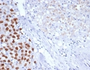 Immunohistochemistry analysis of SALL4 / ZNF797 antibody (clone SALL4/7301) in human pancreas tissue. FFPE human pancreas sections show nuclear HRP-DAB brown staining in a subset of epithelial cells, while surrounding stromal elements demonstrate minimal to no specific signal. The staining pattern is predominantly nuclear, consistent with the expected localization of Sal-like protein 4 as a zinc finger transcription factor. Background staining is low, and cellular morphology is well preserved. The negative control inset, in which PBS was used instead of primary antibody, shows absence of brown chromogenic signal, confirming specificity of primary antibody binding. Heat-induced epitope retrieval was performed by boiling tissue sections in pH 9 10mM Tris with 1mM EDTA for 20 min followed by cooling prior to immunostaining.