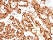 Immunohistochemistry analysis of STAT6 antibody in human renal cell carcinoma tissue (clone STAT6/7163R). FFPE human renal cell carcinoma sections demonstrate strong HRP-DAB brown nuclear staining in tumor epithelial cells forming papillary and glandular structures. The predominant nuclear localization is consistent with activated Signal transducer and activator of transcription 6, reflecting cytokine-driven phosphorylation and nuclear translocation. Cytoplasmic staining can be seen, and surrounding stromal elements show limited background signal. Heat induced epitope retrieval was performed by boiling tissue sections in pH 9 10 mM Tris with 1 mM EDTA for 20 minutes followed by cooling prior to antibody incubation.