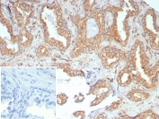 IHC staining of FFPE human prostate carcinoma tissue with RET/Receptor Tyrosine Kinase RET Proto-oncogene antibody (clone RET/7690). Inset: PBS used in place of primary Ab (secondary Ab negative control). HIER: boil tissue sections in pH 9 10mM Tris with 1mM EDTA for 20 min and allow to cool before testing.