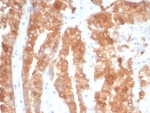 CRYAB Antibody Contractile Stress IHC. Immunohistochemistry of Alpha B crystallin / CRYAB in FFPE human prostate cancer tissue using mouse monoclonal CRYAB antibody, clone CRYAB/4663. HRP-DAB brown staining highlights cytoplasmic labeling of tumor epithelial cells forming glandular structures, with distribution consistent with cytoskeletal stress response and structural stabilization pathways, while surrounding stromal components show reduced staining and nuclei are counterstained blue. Heat induced epitope retrieval was performed by boiling tissue sections in pH 9 10 mM Tris with 1 mM EDTA for 20 min followed by cooling prior to staining.