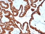 CRYAB Antibody Protein Folding IHC. Immunohistochemistry of Alpha B crystallin / CRYAB in FFPE human kidney cancer tissue using mouse monoclonal CRYAB antibody, clone CRYAB/4665. HRP-DAB brown staining highlights strong cytoplasmic labeling of tumor epithelial cells forming glandular and tubular structures, consistent with molecular chaperone activity and protein stabilization in malignant tissue, while surrounding stromal elements show minimal staining and nuclei are counterstained blue. Heat induced epitope retrieval was performed by boiling tissue sections in pH 9 10 mM Tris with 1 mM EDTA for 20 min followed by cooling prior to staining.