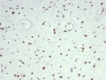 IHC staining of FFPE human rhabdomyosarcoma tissue with MyoD1 antibody (clone MYOD1/7149). HIER: boil tissue sections in pH 9 10mM Tris with 1mM EDTA for 20 min and allow to cool before testing.