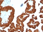 Crystallin Alpha B Antibody Kidney Cancer IHC. Immunohistochemistry staining of FFPE human kidney cancer with Crystallin Alpha B antibody (clone CRYAB/4661). HIER: boil tissue sections in pH 9 10mM Tris with 1mM EDTA for 20 min and allow to cool before testing.