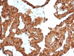 CRYAB Antibody Renal Tumor IHC. Immunohistochemistry of Alpha B crystallin / CRYAB in FFPE human kidney cancer tissue using mouse monoclonal CRYAB antibody, clone CRYAB/4657. HRP-DAB brown staining highlights strong cytoplasmic labeling of tumor epithelial cells forming glandular and tubular structures, consistent with stress-associated chaperone protein expression in malignant tissue, while surrounding stromal elements show minimal staining and nuclei are counterstained blue. Heat induced epitope retrieval was performed by boiling tissue sections in pH 9 10 mM Tris with 1 mM EDTA for 20 min followed by cooling prior to staining.