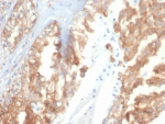 CRYAB Antibody Tumor Stress IHC. Immunohistochemistry of Alpha B crystallin / CRYAB in FFPE human renal cell carcinoma tissue using mouse monoclonal CRYAB antibody, clone CRYAB/4659. HRP-DAB brown staining highlights cytoplasmic labeling of malignant epithelial cells, with variable intensity consistent with stress-associated expression in tumor tissue, while surrounding stromal elements show reduced staining and nuclei are counterstained blue. Heat induced epitope retrieval was performed by boiling tissue sections in pH 9 10 mM Tris with 1 mM EDTA for 20 min followed by cooling prior to staining.