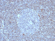 FLI1 Antibody Lymph Node IHC. Immunohistochemistry analysis of FFPE human lymph node tissue stained with recombinant FLI1 antibody (clone FLI1/8318R). Strong nuclear HRP-DAB brown staining is observed throughout lymphoid cell populations, consistent with the expected nuclear localization of Friend leukemia integration 1 transcription factor / FLI1, an ETS family transcription-associated regulatory protein involved in hematopoietic differentiation and immune cell gene expression pathways. Sections underwent HIER using 10mM Tris with 1mM EDTA buffer, pH 9, prior to immunostaining.