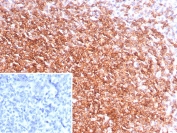 Immunohistochemistry analysis of CXCR5 antibody in human tonsil tissue. FFPE human tonsil sections show strong membranous HRP-DAB brown staining in lymphoid cells within germinal centers, consistent with CXCR5, also known as CD185, expression in follicular B cells and T follicular helper cells. Interfollicular regions show comparatively reduced staining. The inset negative control, in which PBS was used in place of primary antibody, shows no specific brown chromogenic signal. Heat induced epitope retrieval was performed by boiling tissue sections in pH 9 10 mM Tris with 1 mM EDTA for 20 minutes followed by cooling prior to staining.