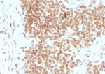 FLI1 Antibody Ewing Sarcoma IHC. Immunohistochemistry analysis of FFPE human Ewing sarcoma tissue stained with FLI1 Antibody / ETS Transcription Factor Marker (clone FLI1/4371R). Strong nuclear HRP-DAB brown staining is observed within tumor cell populations, consistent with the expected nuclear localization of Friend leukemia integration 1 / FLI1, an ETS family transcription factor associated with EWSR1-FLI1-driven oncogenic transcriptional signaling pathways in Ewing sarcoma biology. Sections underwent HIER using 10mM Tris with 1mM EDTA buffer, pH 9, prior to immunostaining.