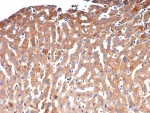 IHC staining of FFPE human hepatocellular carcinoma tissue with Alpha-2-Macroglobulin antibody (clone A2M/4848). HIER: boil tissue sections in pH 9 10mM Tris with 1mM EDTA for 20 min and allow to cool before testing.