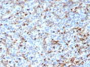 CD163L1 Antibody Human Spleen IHC. Immunohistochemistry staining of FFPE human spleen tissue using CD163L1 antibody demonstrates widespread cytoplasmic and membranous HRP-DAB brown staining in macrophage-rich immune cell populations throughout the splenic tissue. The staining pattern is consistent with expression of CD163 Like 1 / CD163L1, a scavenger receptor family protein associated with monocyte-macrophage lineage cells and innate immune regulation. Clone CD163L1/7971 highlights tissue-resident myeloid cells involved in immune surveillance, phagocytic activity, and maintenance of splenic immune homeostasis. HIER: boil tissue sections in pH 9 10mM Tris with 1mM EDTA for 20 min and allow to cool before testing.