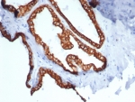 Immunohistochemistry analysis of KRT18 / Cytokeratin 18 antibody (clone rKRT18/7299) in human prostate carcinoma tissue. Formalin-fixed, paraffin-embedded human prostate carcinoma tissue was stained using recombinant KRT18 / Cytokeratin 18 antibody (clone rKRT18/7299). Heat-induced epitope retrieval was performed by boiling tissue sections in 10 mM Tris with 1 mM EDTA, pH 9.0, followed by cooling prior to antibody incubation. Brown chromogenic signal is observed in tumor epithelial cells forming glandular structures, with strong cytoplasmic staining outlining malignant epithelial cells, while surrounding stromal components show little to no staining. This staining pattern reflects epithelial cell-associated expression of Cytokeratin 18 in prostate carcinoma.